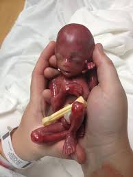 https://yeshua777.files.wordpress.com/2014/05/aborted-fetus.jpg